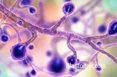 Blastomycosis causes outbreaks.